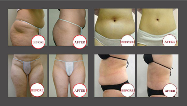 150mv 650nm Lipo Laser Slimming Machine For Fat Removal