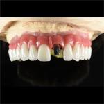 Fixed Restorations Full Arch Zirconia Implant Bridge Denture Teeth