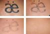 Best High Energy 1500mj 1064nm 532nm Painless Permanent Skin Age Spot Freckle