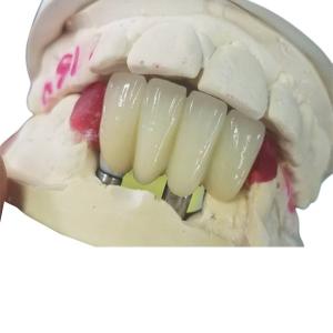 China Strong Ti Base Milling Dental Implant Crowns Tooth Supported Bridge wholesale