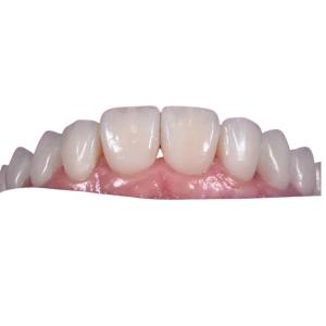 China 0.3MM Whitening Ceramic Dental Crown To Replace Unhealthy Teeth wholesale