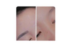 Picosecond Laser Tattoo Removal Equipment , Nd Yag Laser Equipment High Energy