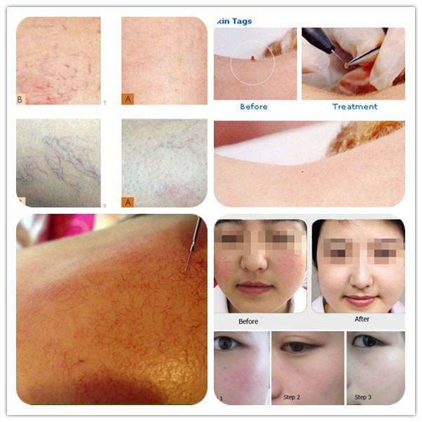 2015 newest high frequency 30mhz spider vein removal machine