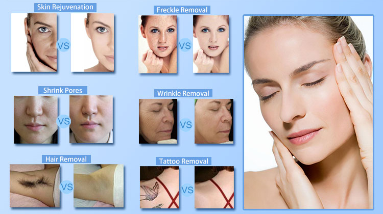 Electrolysis OPT SHR Machine , 4 in 1 IPL SHR Beauty Equipment