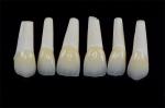 Handcrafted Porcelain Feldspathic Dental Veneer Natural Looking