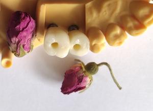 China Cemented Implants Crowns Bridges wholesale