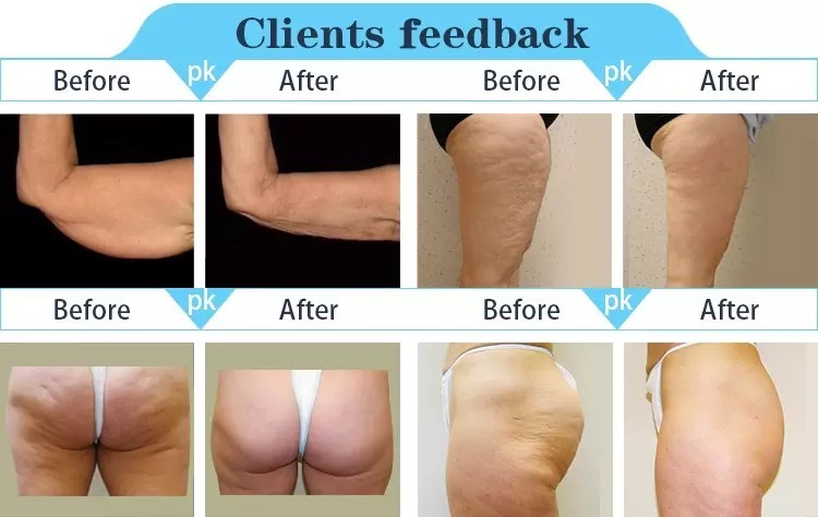 Best Multifunction 3D Lipo Body Shape Ultrasonic RF Vacuum Cavitation Face Lifting Slimming RF Skin Tightening Machine