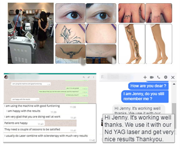 2018 trend product 1064 nm 532nm q switched nd yag laser for melasma