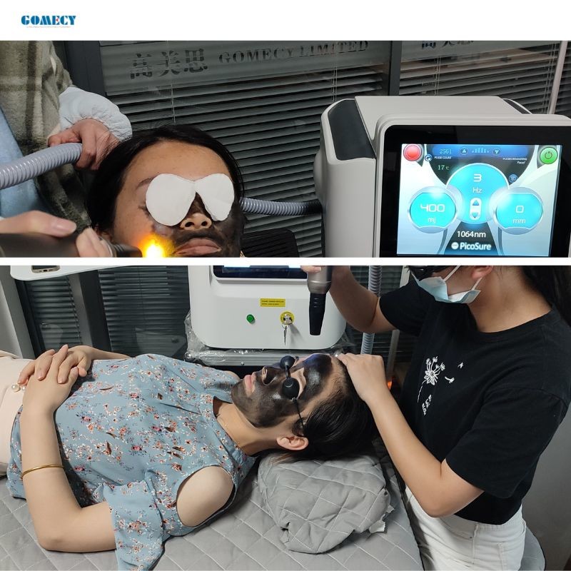 Gomecy Pro ND YAG Pico Laser Machine for Treating Facial Pigmentation and Scars and Tatttoo Removal