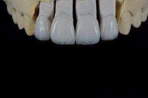 China Handcrafted Porcelain Feldspathic Dental Veneer Natural Looking wholesale