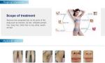 Painless treatment 808nm diode laser permanent hair removal / skin rejuvenation