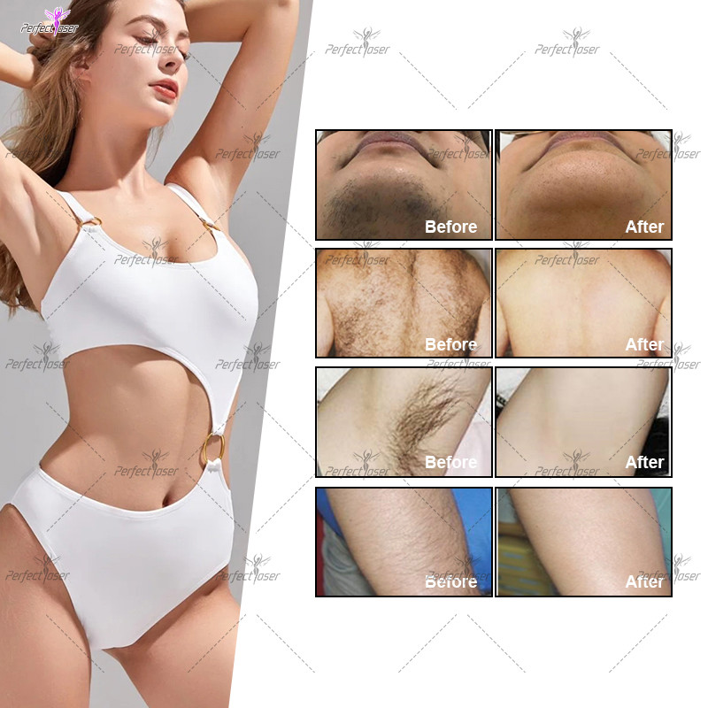 Advanced 808nm Diode Laser Hair Removal Machine with Wavelength 755nm 808nm 1064nm and Spot Size 15*26mm