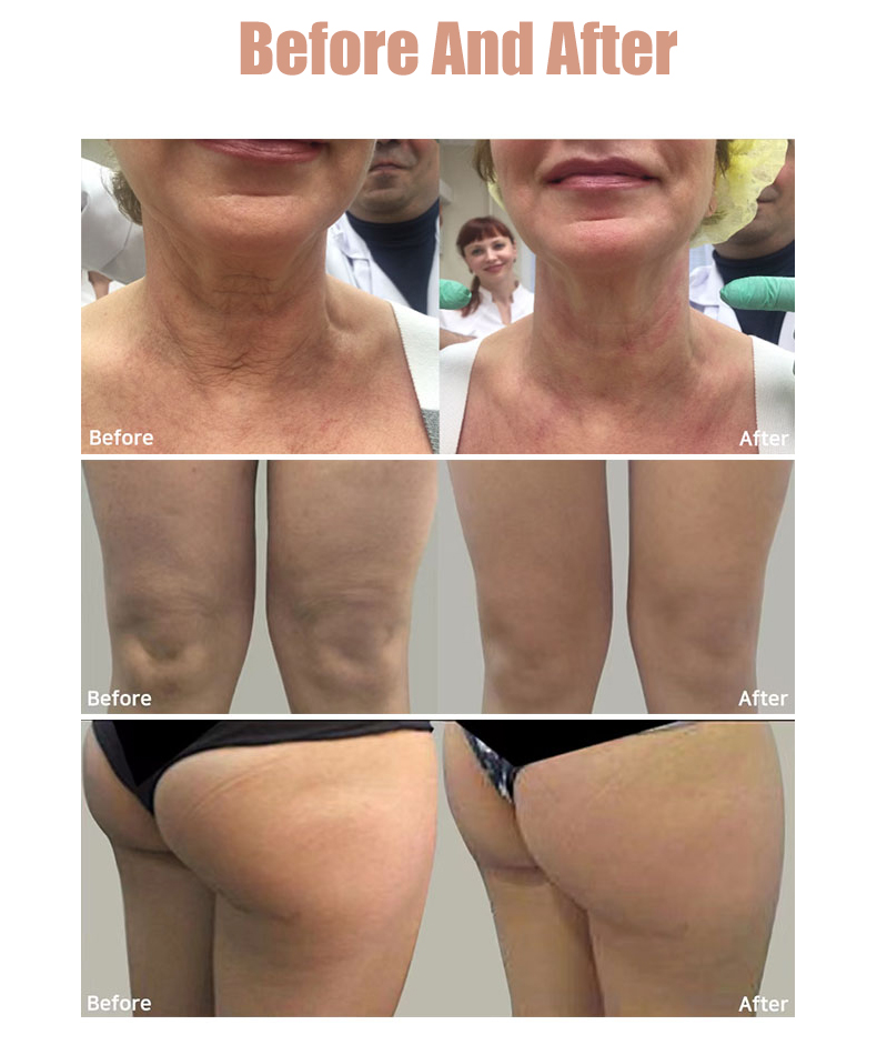 MFU RF Ultrasonic Hifu Beauty Machine For Face Lifting Skin Tightening Wrinkle Reduction Body Firming Treatment