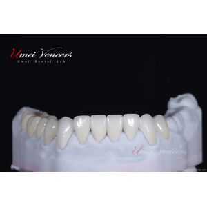Super Natural Hollywood Veneers