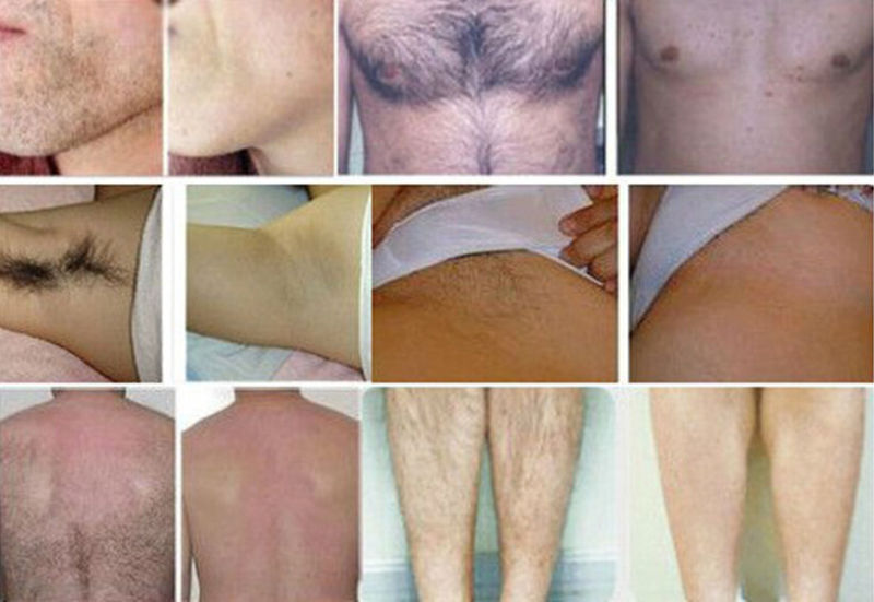 Hair Removal 808nm Diode Laser Beauty Equipment