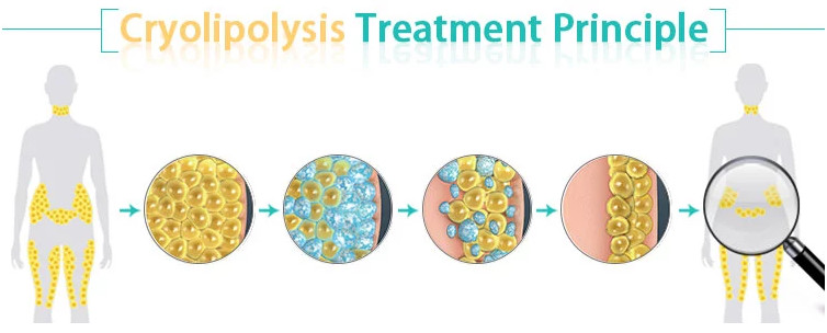 cryotherapy and weight loss unique double chin treatment cryolipolysis cellulite reduce machine