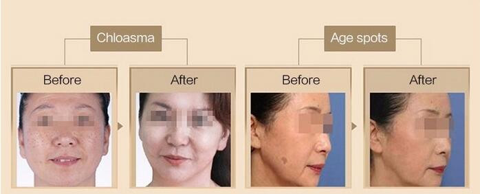 Picosecond q switched nd yag laser picosure q-switched tattoo removal laser machine