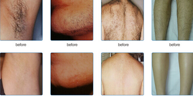 Laser Diode Hair Removal Machine