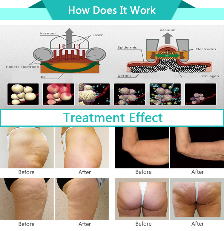 FDA approved ultrasound cavitation Radio frequency lpg endermologie machine price