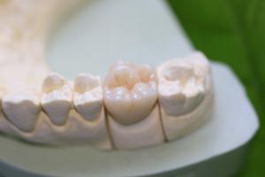 China Aesthethics Glass Ceramic EMAX Posterior Crowns For Molars wholesale