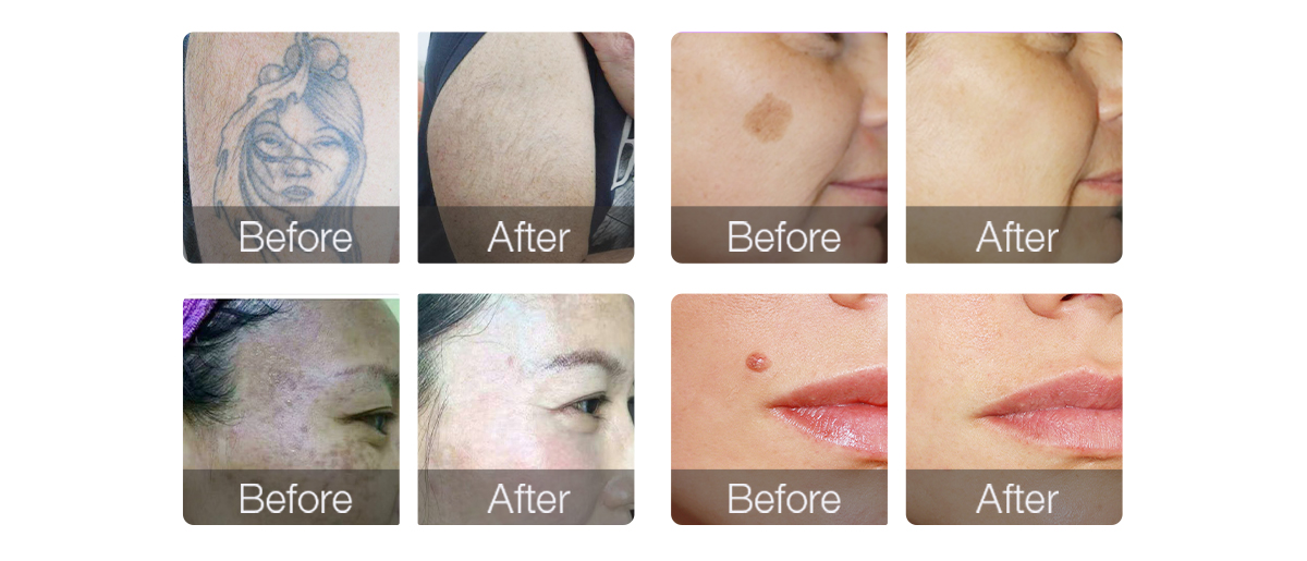 Q Switched 1064nm Nd Yag Chloasma Removal Tattoo Removal Remove Spots Picosecond Laser Machine