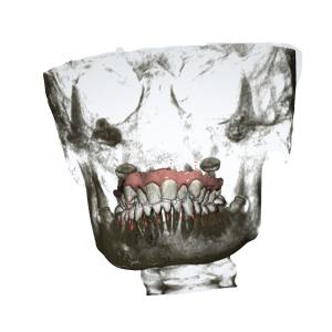 China Accurate Removable Orthodontic Appliance OEM Rapid Palatal Expander wholesale