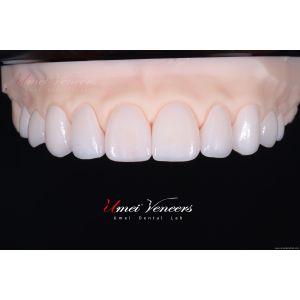 China Durable Whitening porcelain veneer wholesale
