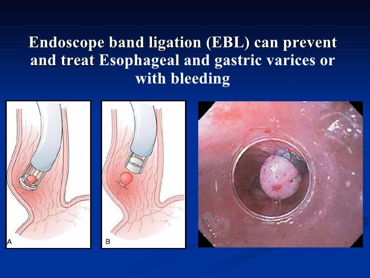 Ligator of Esophageal Varices of medical equipment for esophagus bleeding from Chinese manufacturer
