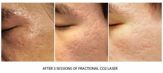 Fractional Co2 Laser Skin Resurfacing Machine , Viginal Tightening Machine CE FDA