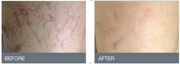 15W 30W 60W 980nm Laser Pigmentation Removal Machine AC100-240V