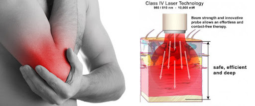 980nm High Intensity Laser Therapy Equipment Sports Injury Wound Healing
