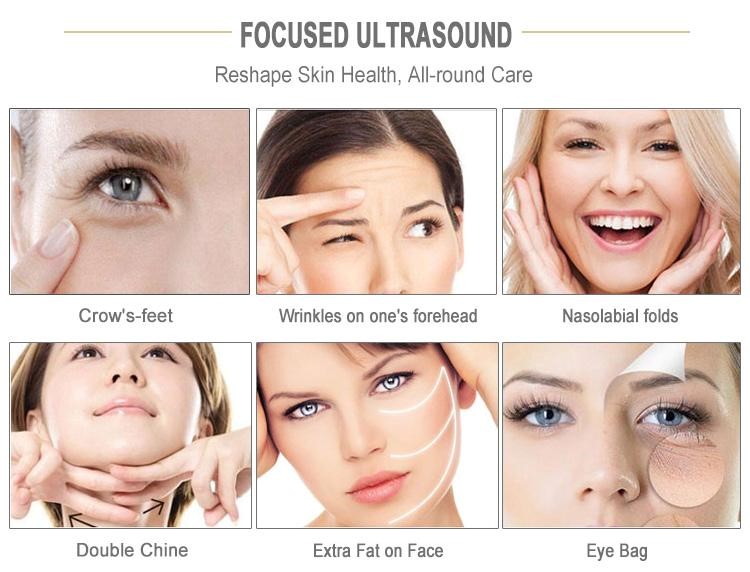 IPL Skin Tightening | Redeem MediSpa Brampton & Vaughan