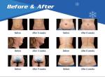cryolipolysis slimming machine, fat freeze weight loss, 5 handles, China
