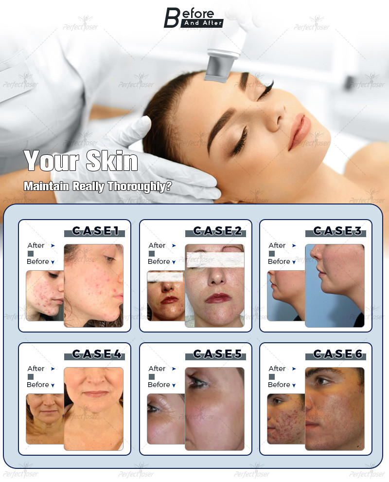 13 In 1 Water Oxygen Jet Peel Machine 250VA Hydrafacial Dermabrasion Device