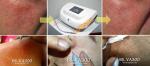 Vein Vascular removal high frequency spider veins vascular removal equipment