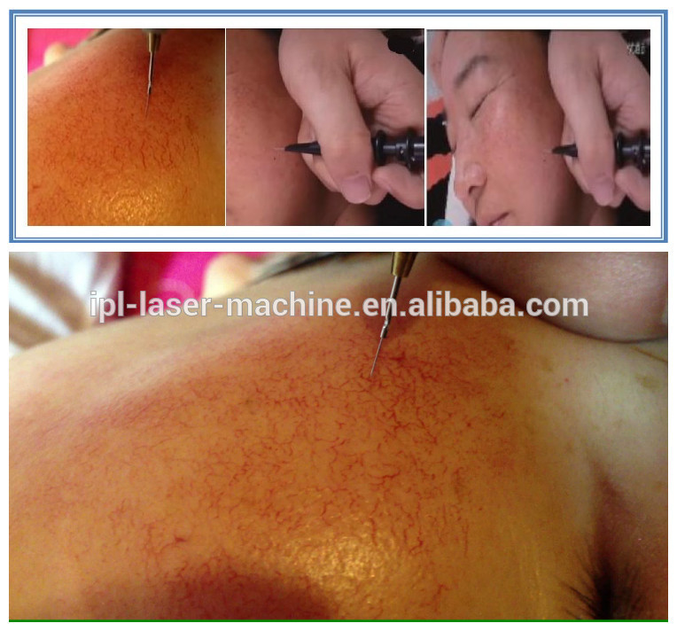 spider vein removal machine8.jpg