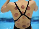Vacuum Electrode Cupping Therapies Lymph Edema Electric Slimming Russian Wave