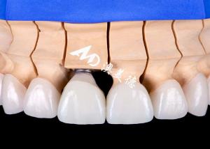 China Functional Aesthetic Dental Implant Crown Bridge – Precision and Durability wholesale
