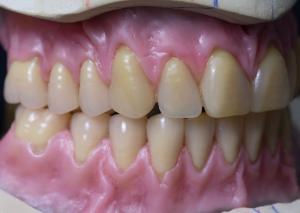 China Hot Cured Full Arch Removable Acrylic Full Denture wholesale
