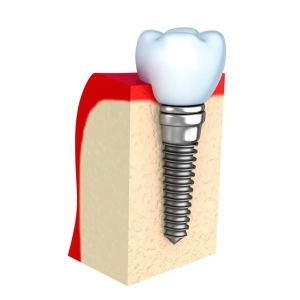 China Dentures Temporary Dental Implant Bar Single All Ceramic Teeth wholesale
