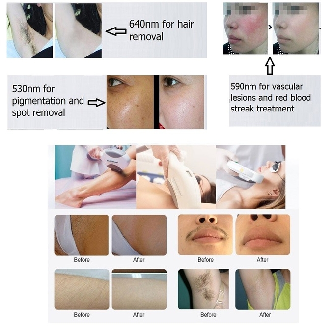Super OPT SHR Hair Removal IPL Skin Rejuvenation Machine For Beauty Salon
