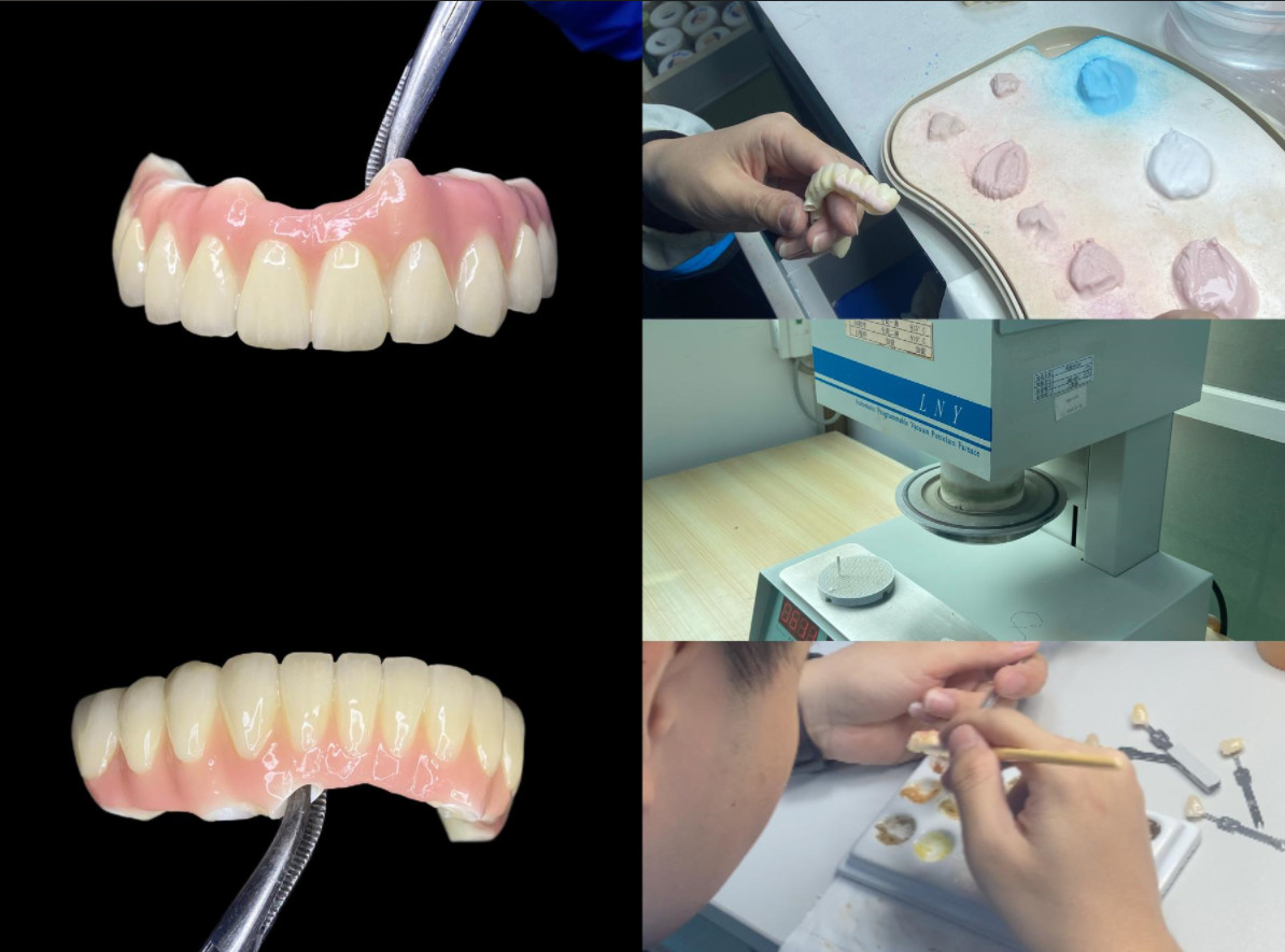 Polished Surface Dental Implant Screw Retained Crown For Tooth Replacement