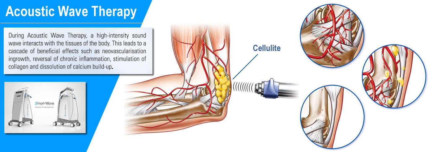 Continuously Muscle And Connective Tissue Tightening With Radial Acoustic Shockwave