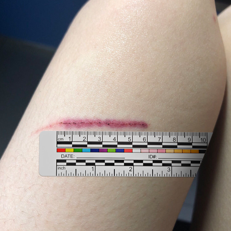 Self Ahesive Wound Treatment Medical Tape Measure Ruler For Nurses Documentation