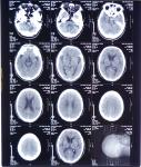 11X14 Inch Medical X-ray Film/Analogue Medical Film/Dry Film