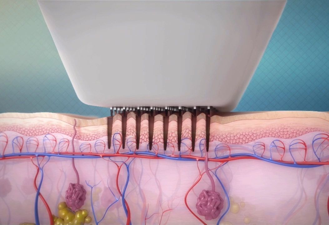 Fractional Radiofrequency Skin Resurfacing (Viva) - Dr. Martha E ...