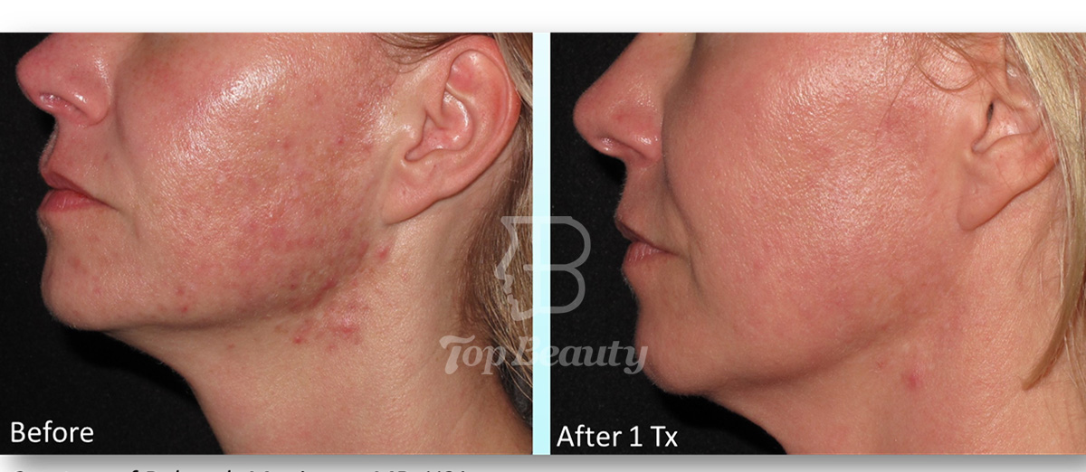 Skin Care Fractional Rf Microneedle Machine Body Radiofrequency Microneedle Beauty Equipment