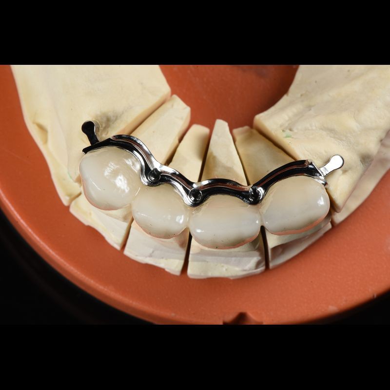 Aesthetic Partial Denture Precision Attachments Medical Grade OEM