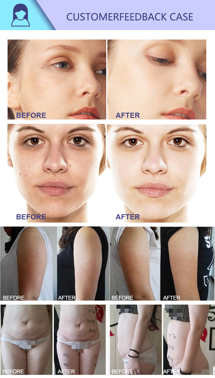 80K Non Invasive Body Contouring Machine RF Vacuum Roller Cellulite Removal Device