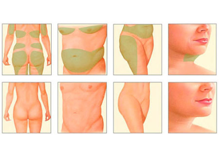 Arms Legs Laser Lipolysis Machines